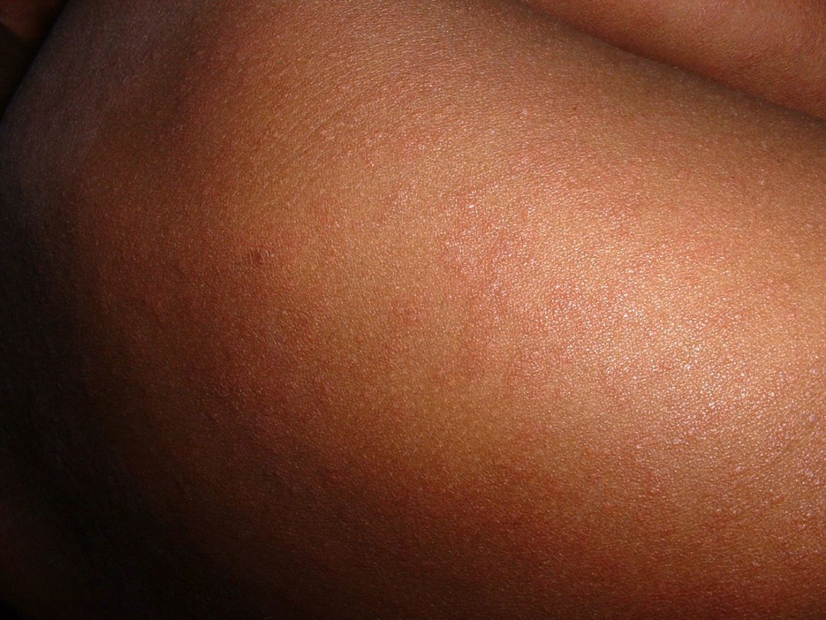 Measles outbreak confirmed in NW Namibia