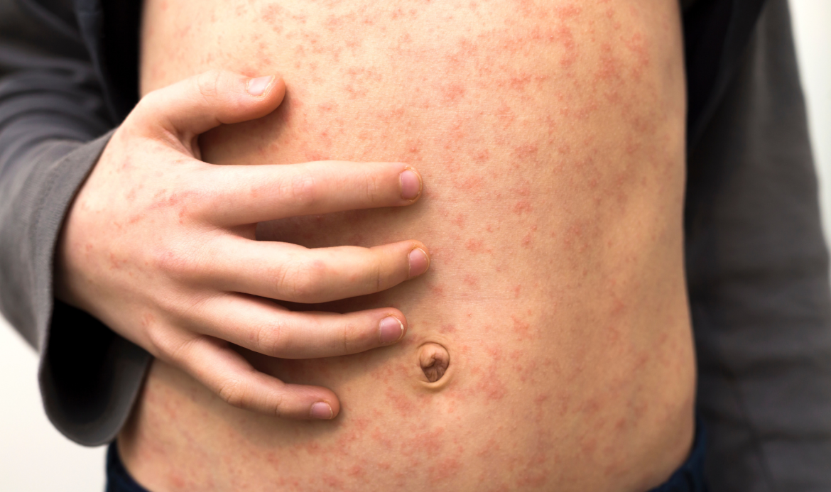 Experts warn U.S. risks losing measles elimination status