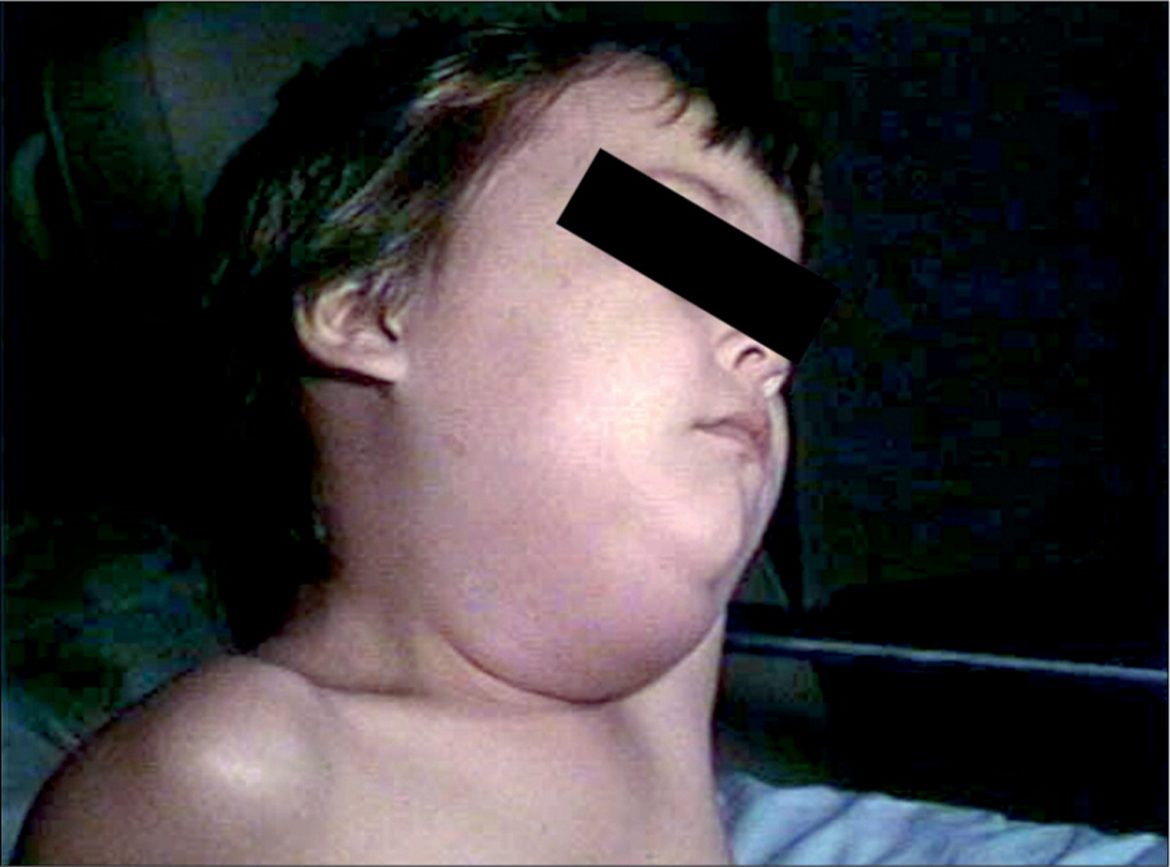 Mumps outbreak reported in Swakopmund district