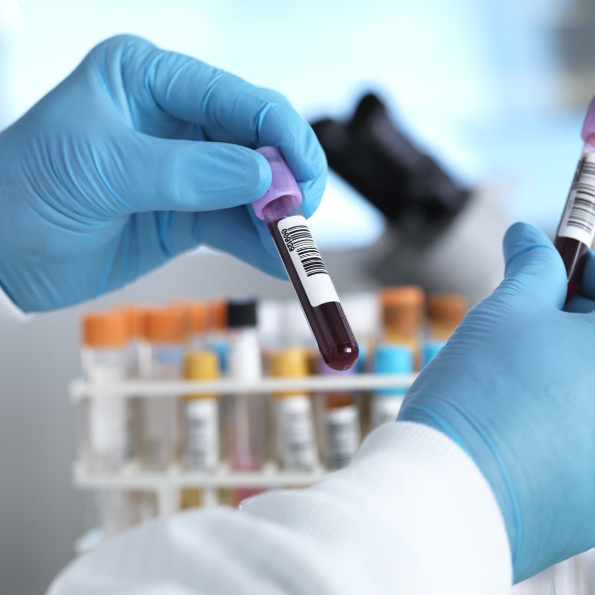 Australian blood test detects early cancers using 4 key proteins